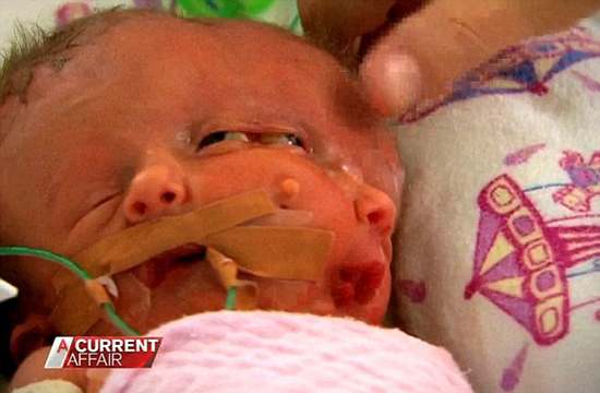 Décès du bébé au ? double visage ? en Australie