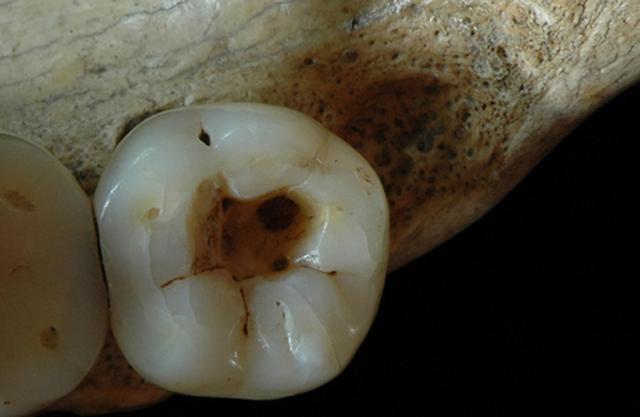 La dent cariée, soignée avec du silex.