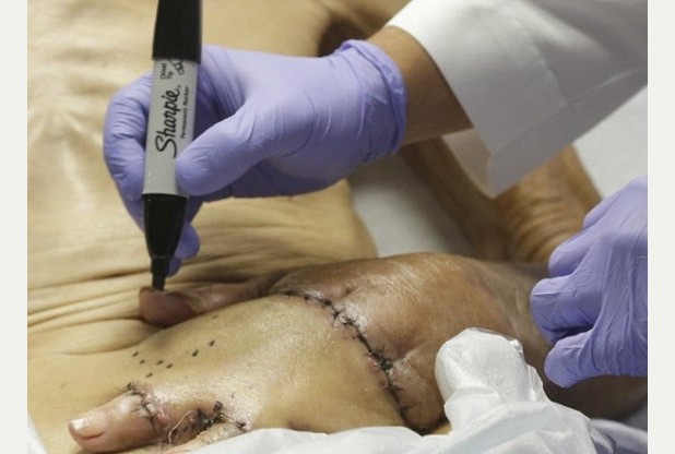 Un Américain voit sa main greffée sur son ventre pour éviter l'amputation