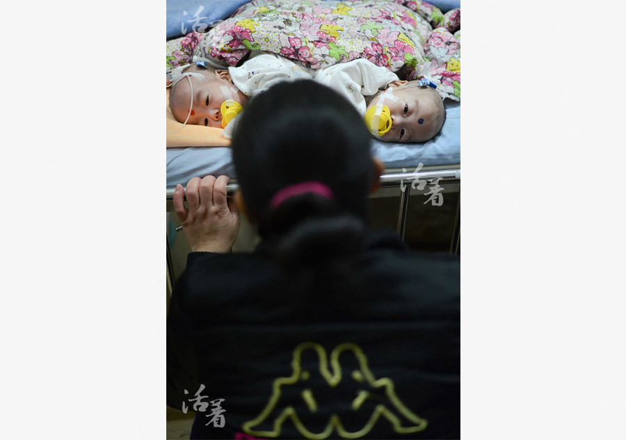 Succès de l'opération des frères siamois : bonheur et amertume pour la famille