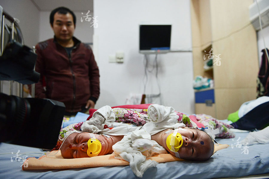 Succès de l'opération des frères siamois : bonheur et amertume pour la famille