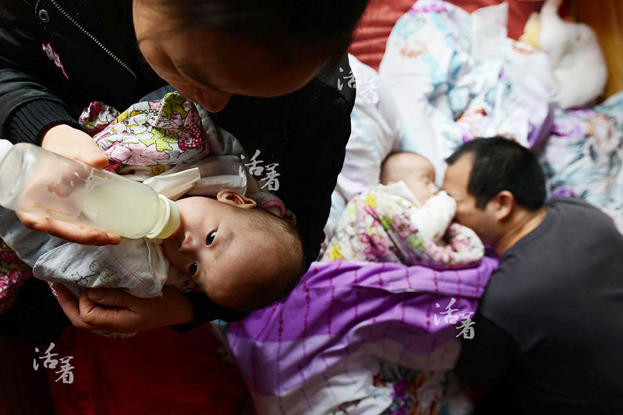 Succès de l'opération des frères siamois : bonheur et amertume pour la famille