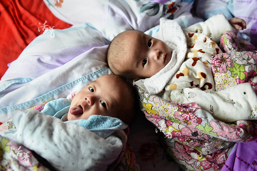 Succès de l'opération des frères siamois : bonheur et amertume pour la famille