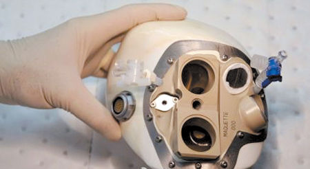 France : première implantation d'un coeur artificel autonome 